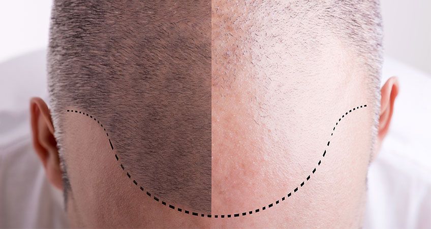 Why Men Are Going Bald Younger