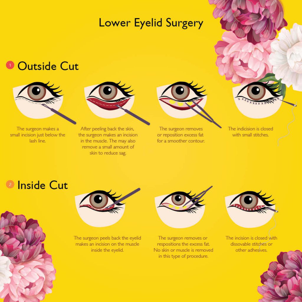 An Eye Obsession All You Need To Know About Cosmetic Eye Surgery
