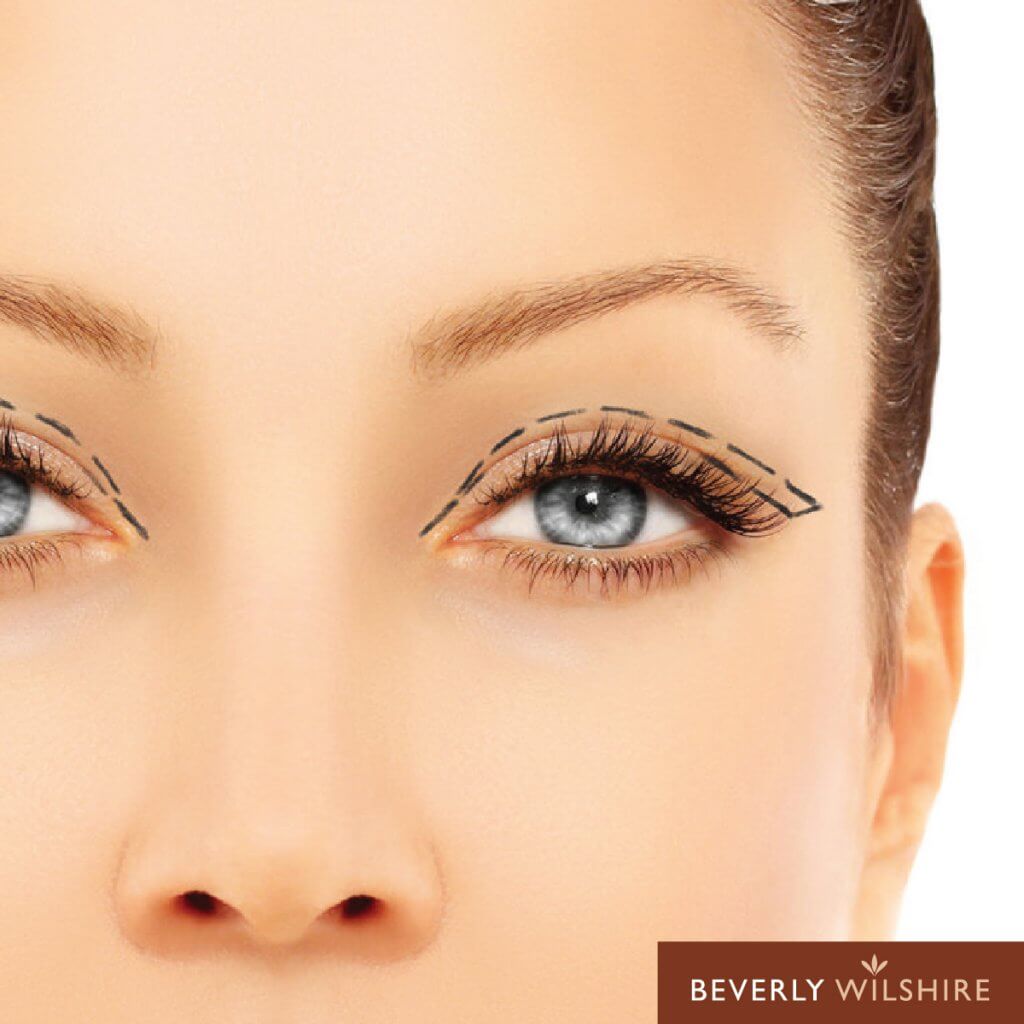 6 Things You Should Know Before Getting Double Eyelid Surgery
