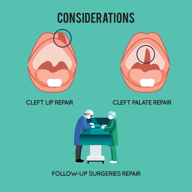 Cleft Lip & Palate Beverly Wilshire Medical