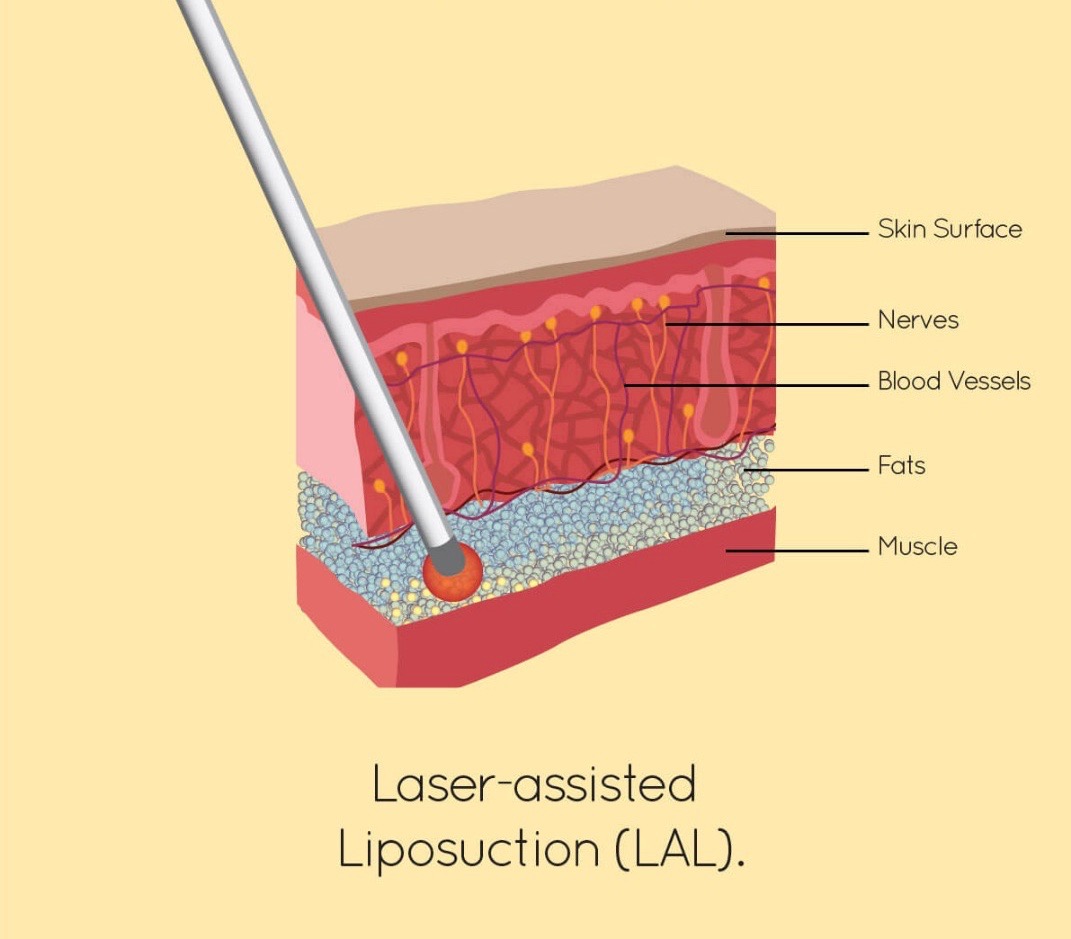 Liposuction