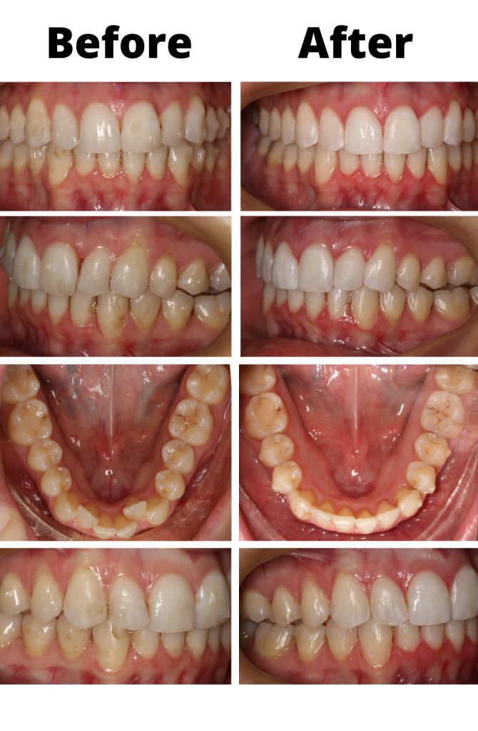 Invisalign