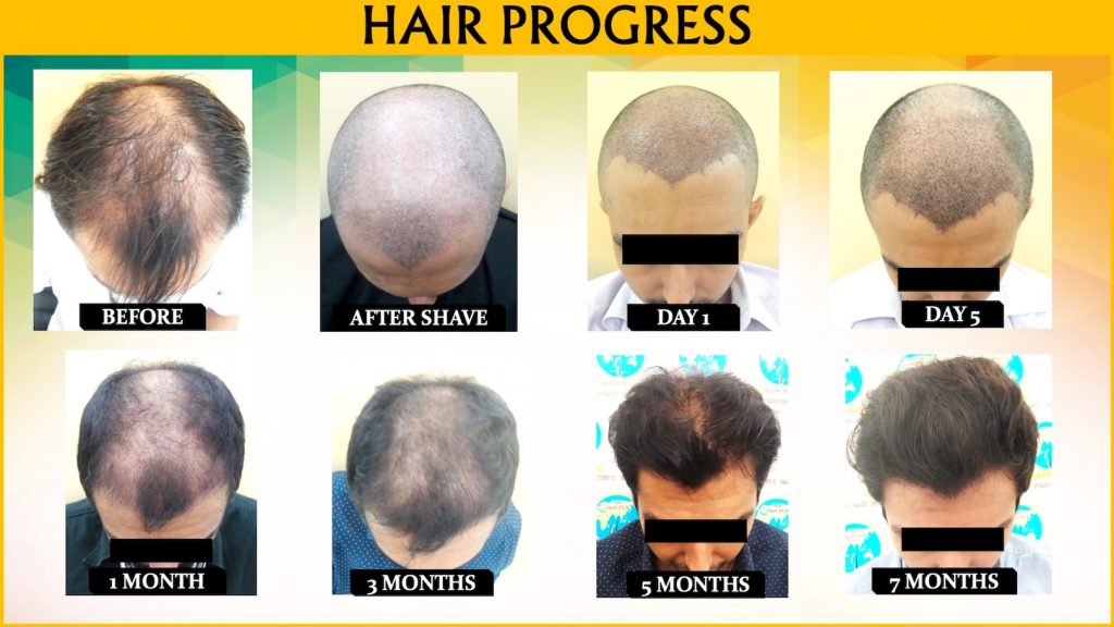 SMART™ FUE Hair Transplant (male)