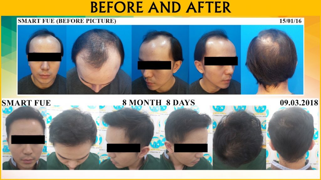 SMART™ FUE Hair Transplant (male)