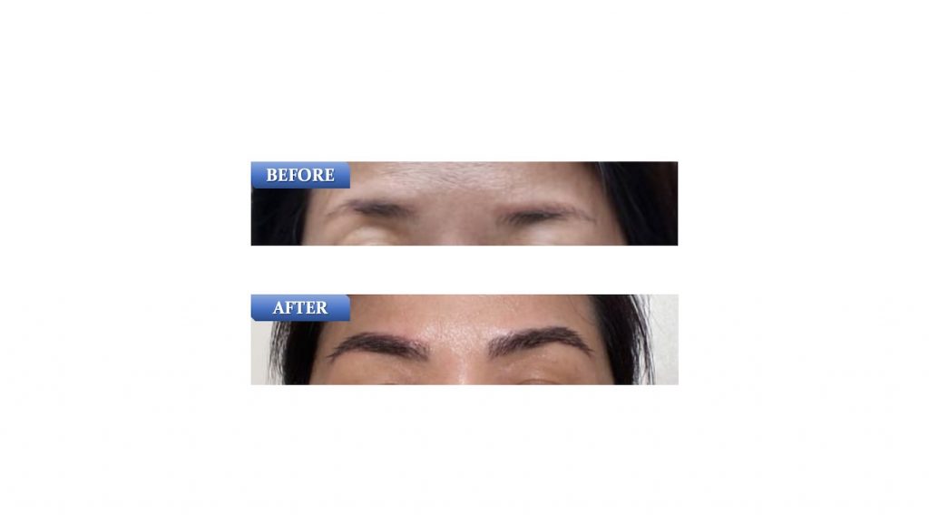 SMART™ FUE Eyebrow Transplant (female)